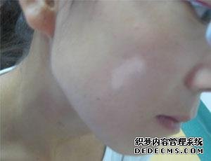 消除面部白癜风 生活回归精彩